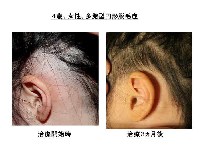 円形脱毛症　病院